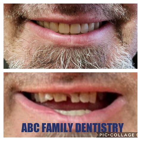 Family Dental Clinic In Greeneville Tn Hometown Dental Pplc